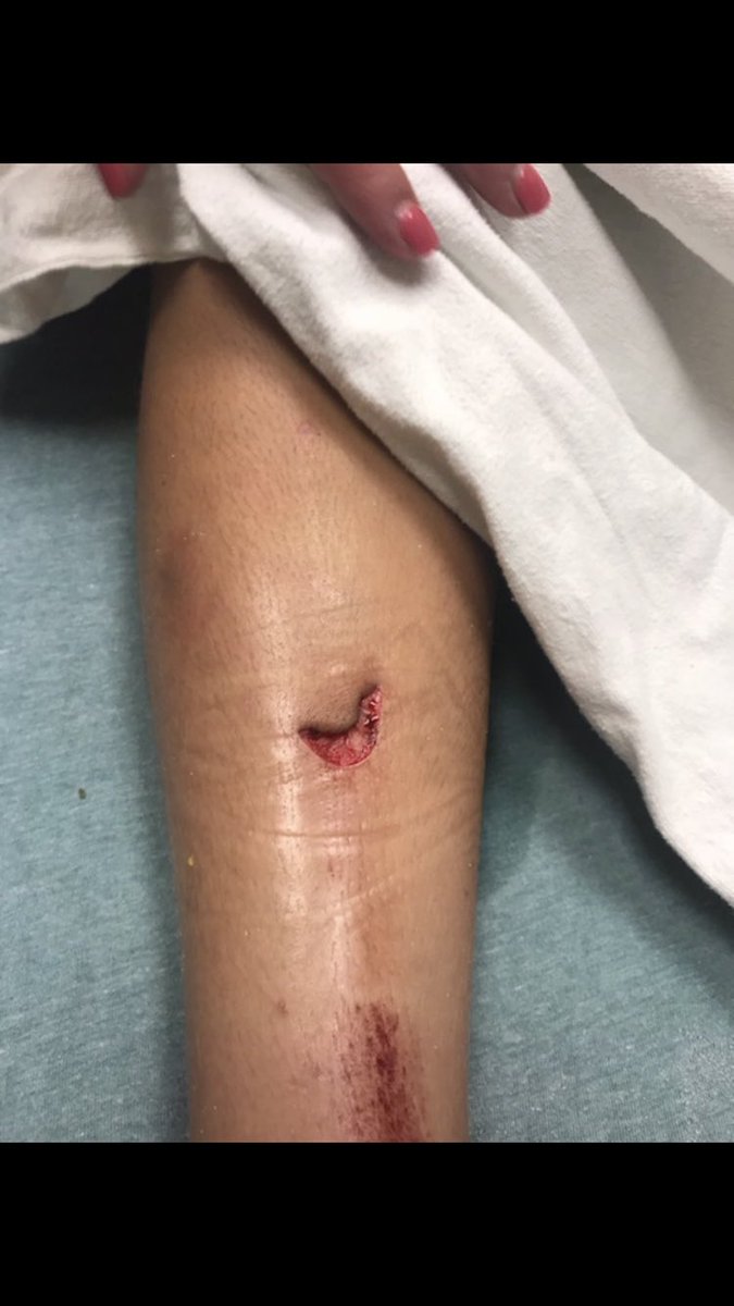 Lil bro got attacked by a stingray