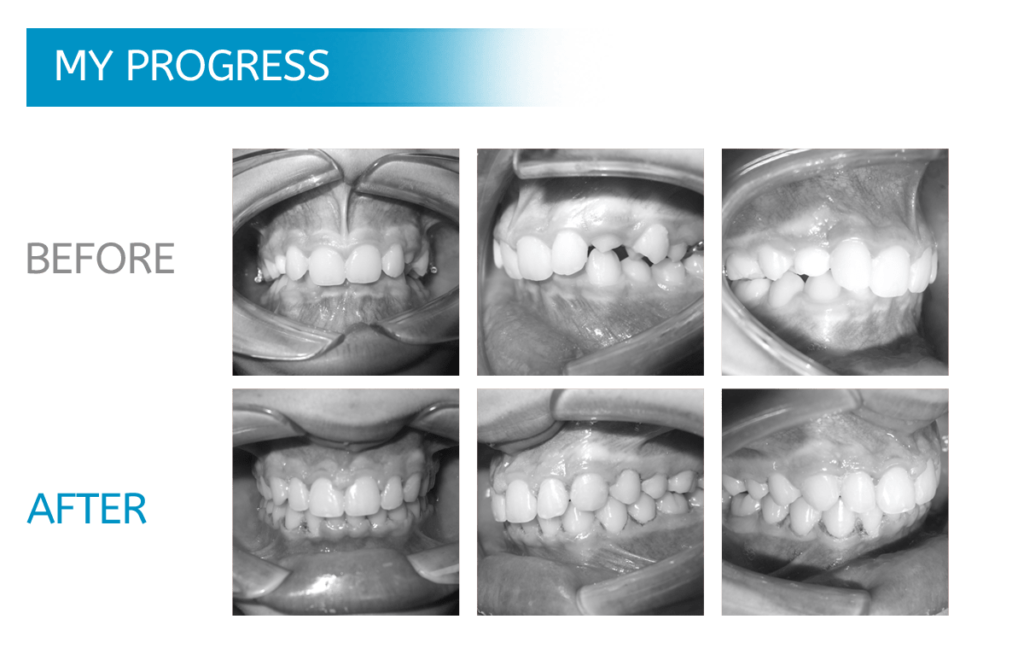 MidwestOrthodon's tweet photo. Ever 😍fall in love😍 with someone's smile? ☺️ Wouldn't it be great if someone could see that in YOU?
👉WE CAN!👈 Call Midwest Orthodontics @ (855) 654-8355 today! #WeCan #YouCanToo https://t.co/zlwi6xz0zE