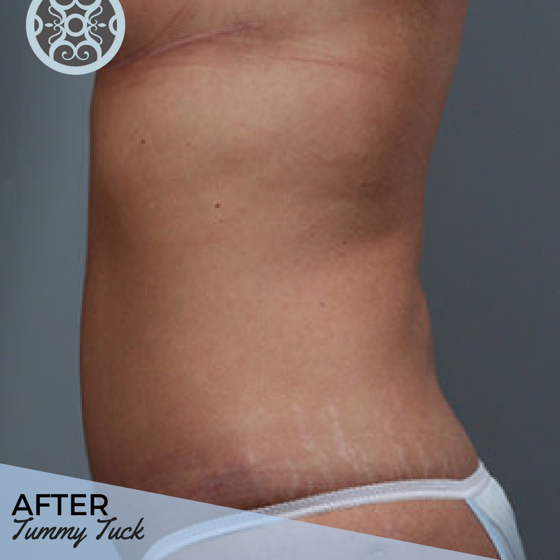 JohnSymbasmd's tweet photo. If you've followed along with the #ATLPlastic team here, you've no doubt heard us talk about the wonders liposuction or a tummy tuck can work for you. Now SEE their amazing effect. Swipe to see the transformation. https://t.co/PasGfUzFw9