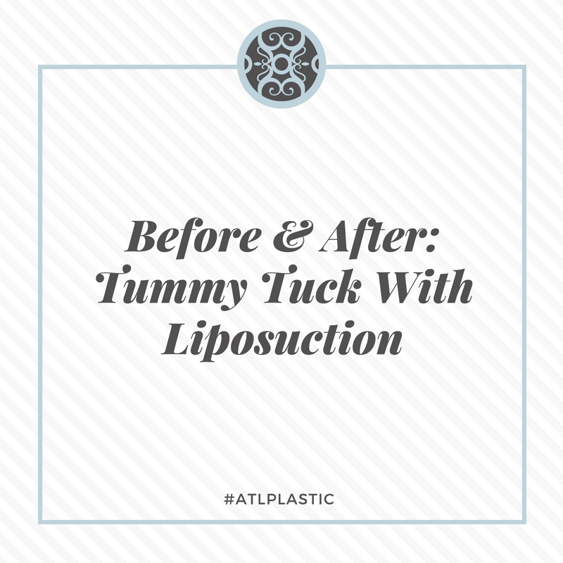 JohnSymbasmd's tweet photo. If you've followed along with the #ATLPlastic team here, you've no doubt heard us talk about the wonders liposuction or a tummy tuck can work for you. Now SEE their amazing effect. Swipe to see the transformation. https://t.co/PasGfUzFw9