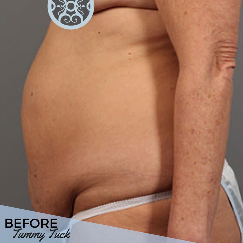 If you've followed along with the #ATLPlastic team here, you've no doubt heard us talk about the wonders liposuction or a tummy tuck can work for you. Now SEE their amazing effect. Swipe to see the transformation.