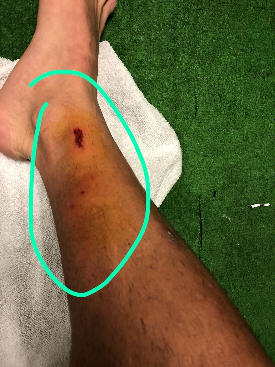 Raspones En La Pierna - Asesores