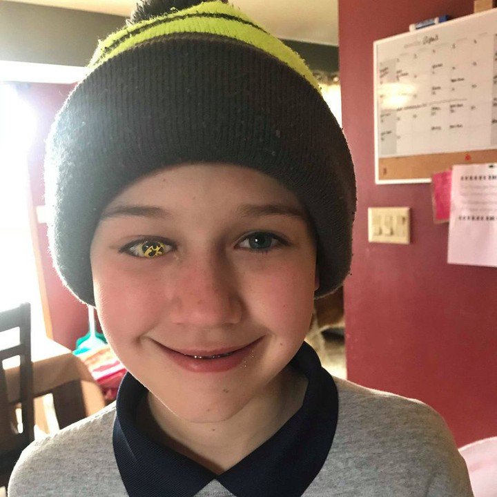 Colton Barker, who lost his eye battling cancer, proudly shows his Hawkeye pride through this prosthetic eye. His dad, Justin, credits <a href="/UIchildrens/">UI Health Care Stead Family Children's Hospital</a> with saving his son's life eight years ago.