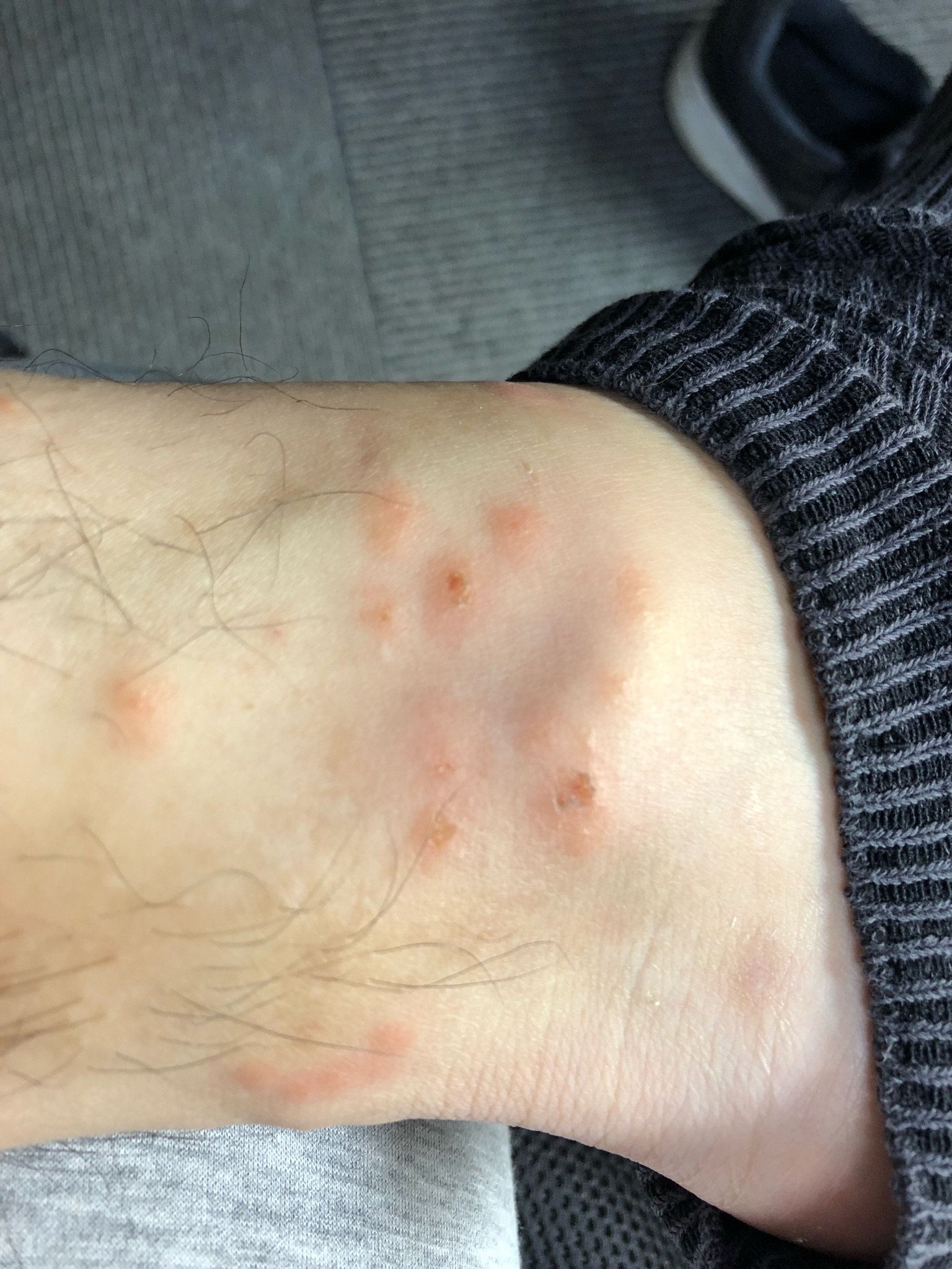 やぎ 中華カーボンemtb Na Twitterze 土曜日の虫刺され被害 両足首 蚊なのか ブヨなのか T Co Rfryumcb2t Twitter