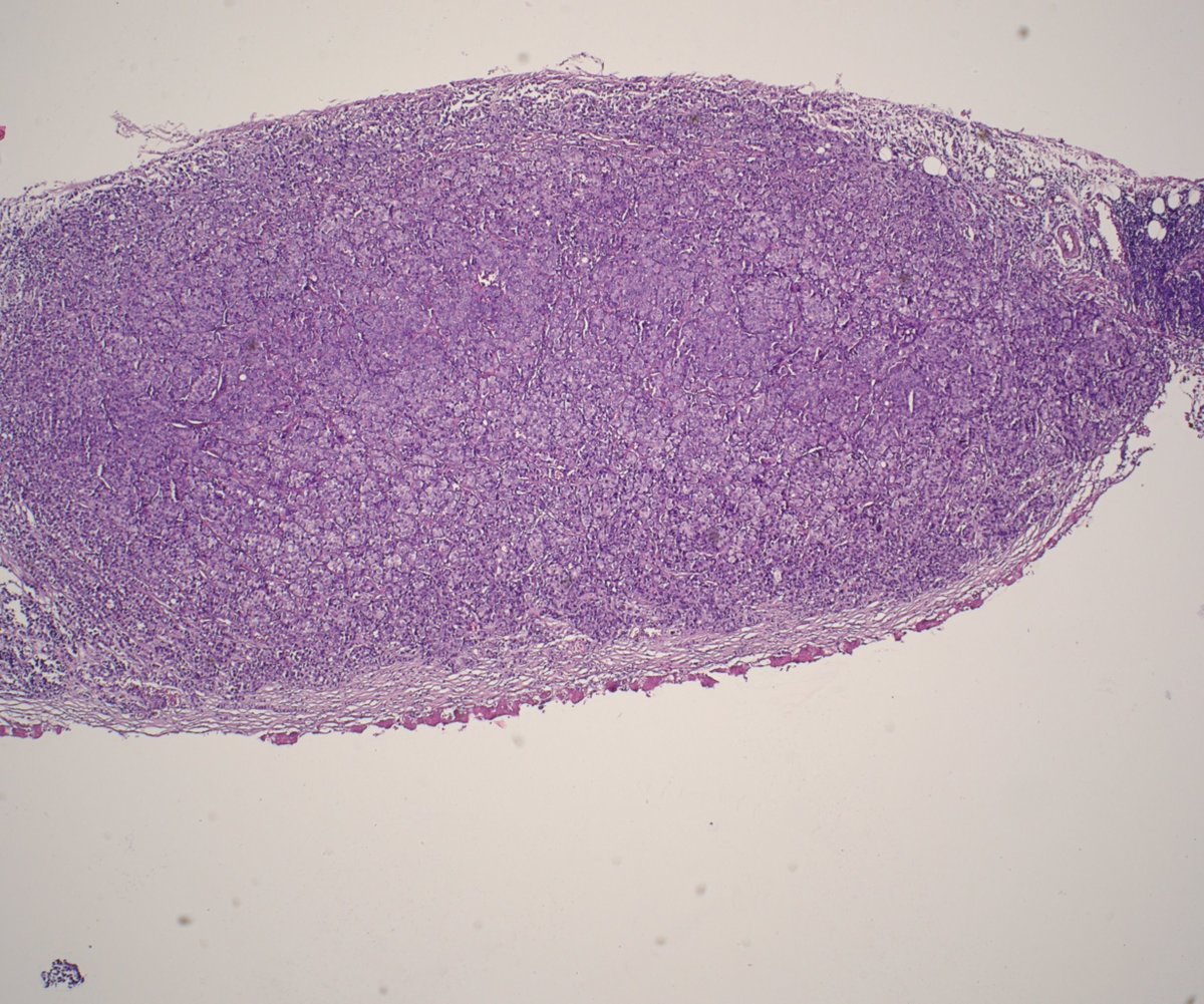 LisieviciC's tweet photo. Pleural metastases in a patient with history of invasive ductal (NST) breast carcinoma🧐 #pathology #metastaticbreastcancer https://t.co/nkb2SDpyCx