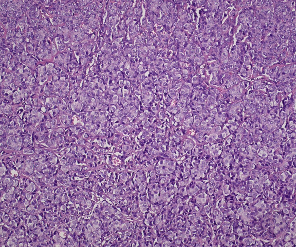 LisieviciC's tweet photo. Pleural metastases in a patient with history of invasive ductal (NST) breast carcinoma🧐 #pathology #metastaticbreastcancer https://t.co/nkb2SDpyCx
