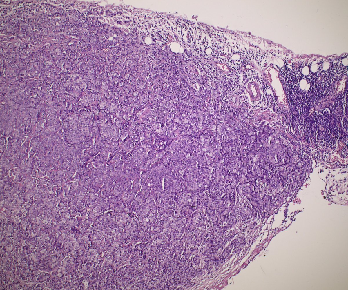 LisieviciC's tweet photo. Pleural metastases in a patient with history of invasive ductal (NST) breast carcinoma🧐 #pathology #metastaticbreastcancer https://t.co/nkb2SDpyCx
