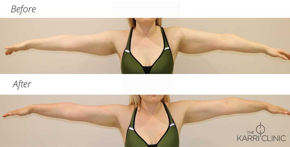 Wingspan of dreams! Happy Monday everyone - here's hoping this week is as successful as are wonderful patient's #armliposuction was. Did we mention we love what we do? Get in touch if you want to discuss any surgeries/procedures: 01482 976 980 or email  info@thekarriclinic.co.uk.