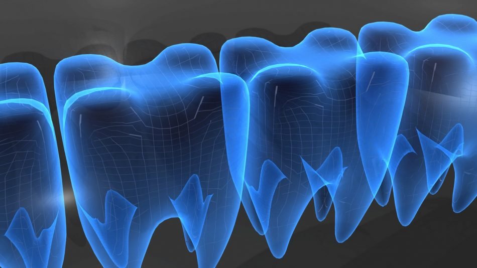 Comparison of the shaping ability of various nickel–titanium file systems in simulated curved canals #dental2018 #dentalcongress #dentalmeetings
for more informationhttp://dental.alliedacademies.com/: