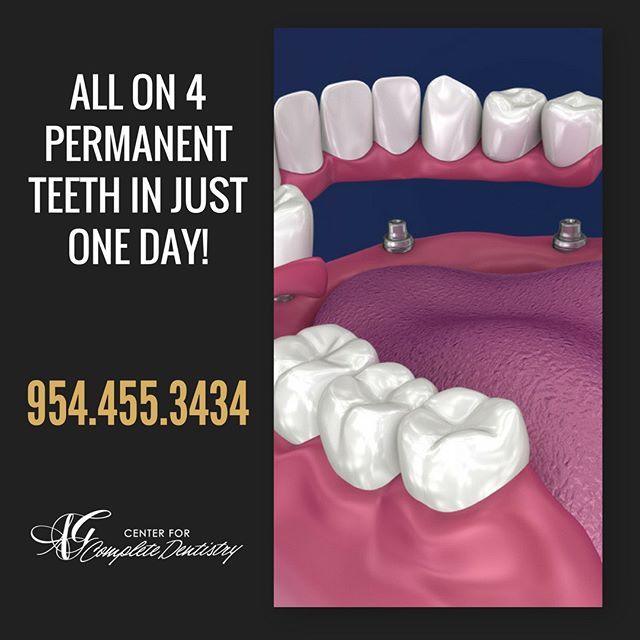 cfcdsfl's tweet photo. All on 4 was developed as a way to best restore the full arches of the upper and lower jaws.

This technique provides our patients with a non-removable dental arch that is secured by as little as four dental implants – all on the same day. All on Four is… https://t.co/Ax6rZUiKOc https://t.co/ljV3201PTd
