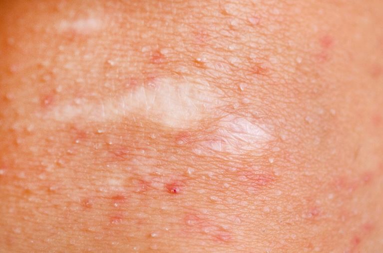 Everyday Health Twitter પર Acne Like Bumps On The Buttocks Are