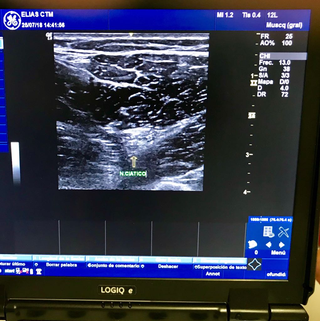 Localización del nervio ciático con ecografía para tratar posteriormente con neuromodulación :D