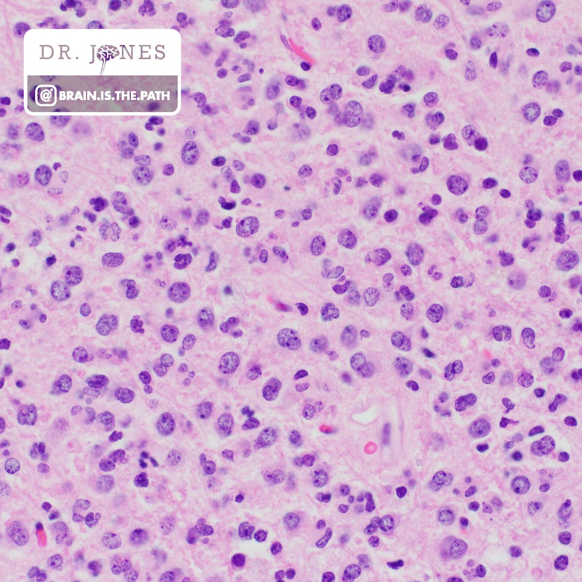 Frontal lobe mass in adult. How would you work it up?

1. H&amp;E differential?
2. IHC to order?
3. Molecular to order?

#neuropath #PathResidents <a href="/UIPathology/">University of Iowa Pathology</a> <a href="/neuropathology/">AANP</a> @kylesconway <a href="/Path_InSitu/">drMoh</a> <a href="/DrMikeLMiller/">Michael L Miller, MD, PhD</a> <a href="/thebigcobb/">Rachael Vaubel</a> <a href="/astroade/">Astroade</a> <a href="/PathologySayah/">Maryam Sayah, MD</a> <a href="/JaredAhrendsen/">Jared T. Ahrendsen MD, PhD (AP/NP/FP)</a>