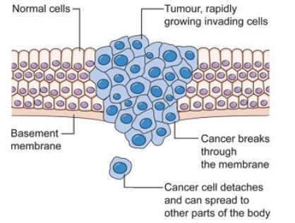 Run4theCureRD's tweet photo. A cancerous tumour is a group of cancer cells that can destroy nearby tissue and spread to other parts of the body. In recognition of #BreastCancerAwarenessMonth, be aware of how breast cancer is caused and join the fight to #MakeBreastCancerBeatable!
https://t.co/4tluONyS0G https://t.co/l9Tn18PQj7