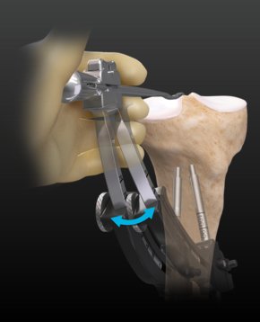 ArthrexUK's tweet photo. @MichaelStuartMD &amp; @DrKrych from the @MayoClinic take us through a #MeniscalRootRepair using the new rotating marking hook. This is always a difficult procedure. Let #ArthrexUK help make it easier https://t.co/xr6opNltpx
#HelpingSurgeonsTreatTheirPatientsBetter #WhatsNewAtArthrex https://t.co/6hySyMyAQm