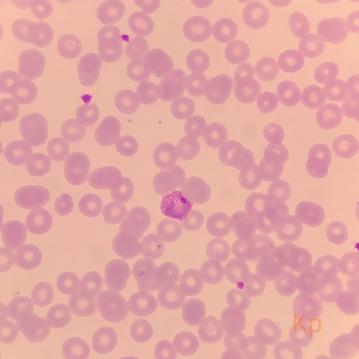 Pankaj kumar (@bsc_pankaj) on Twitter photo The 2nd species. <a href="/drsps2k6/">Praveen Sharma</a> <a href="/smlungpathguy/">Sanjay Mukhopadhyay</a> <a href="/KDannheimMD/">Kate Dannheim, MD, FCAP (she/her)</a> @AnneE_AP <a href="/path_lab/">Dr. SHUKLA PATH LAB</a> The 2nd species. <a href="/drsps2k6/">Praveen Sharma</a> <a href="/smlungpathguy/">Sanjay Mukhopadhyay</a> <a href="/KDannheimMD/">Kate Dannheim, MD, FCAP (she/her)</a> @AnneE_AP <a href="/path_lab/">Dr. SHUKLA PATH LAB</a>