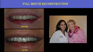arrowheadpros's tweet photo. The Arrowhead Dental Clinic’s expert dentists offer top quality dental treatment. For ALL ON 4 dental implants in Phoenix, AZ, book an appointment with the specialist! https://t.co/MjheNnKVTM