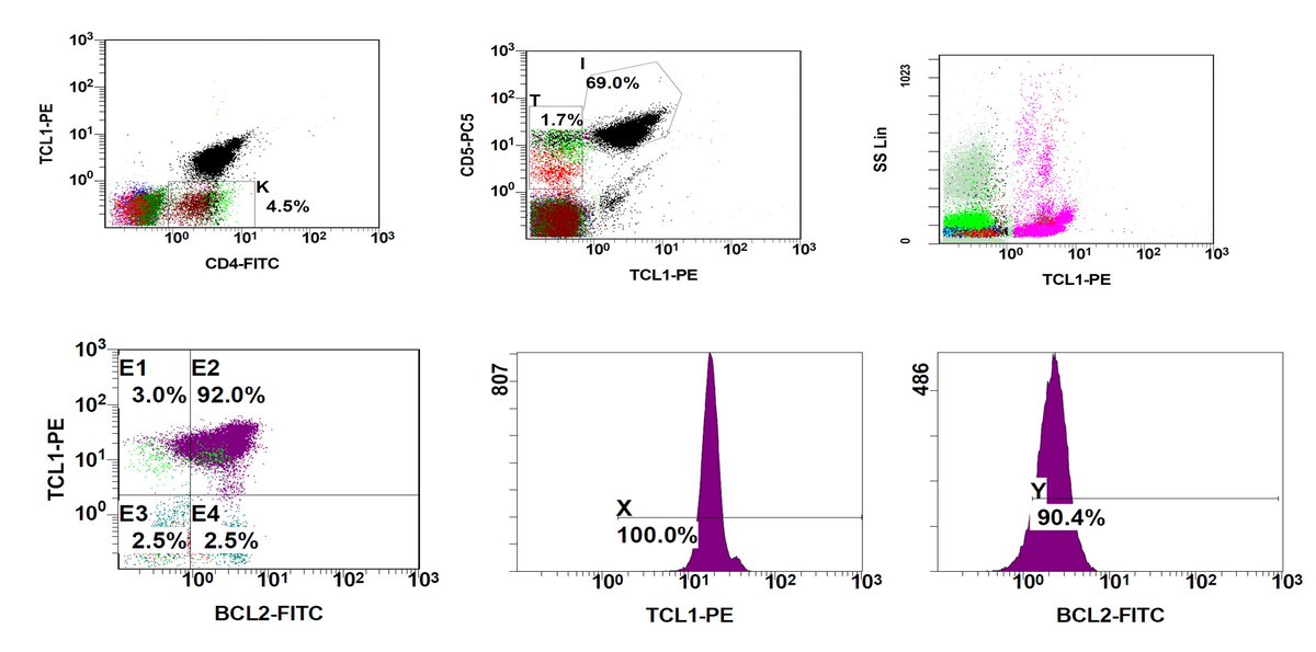 QUIZ(cont) 79F,  Hyperleucocytosis, supraclavicular lymphadenopathy and splenomegaly (20cm). Flow cytometry showed 2.5% clonal B cells and an abnormal population CD45 negative CD3-CD4+. The immunophenotype of the atypic CD45 negative cells and B cells is presented >#hemepath