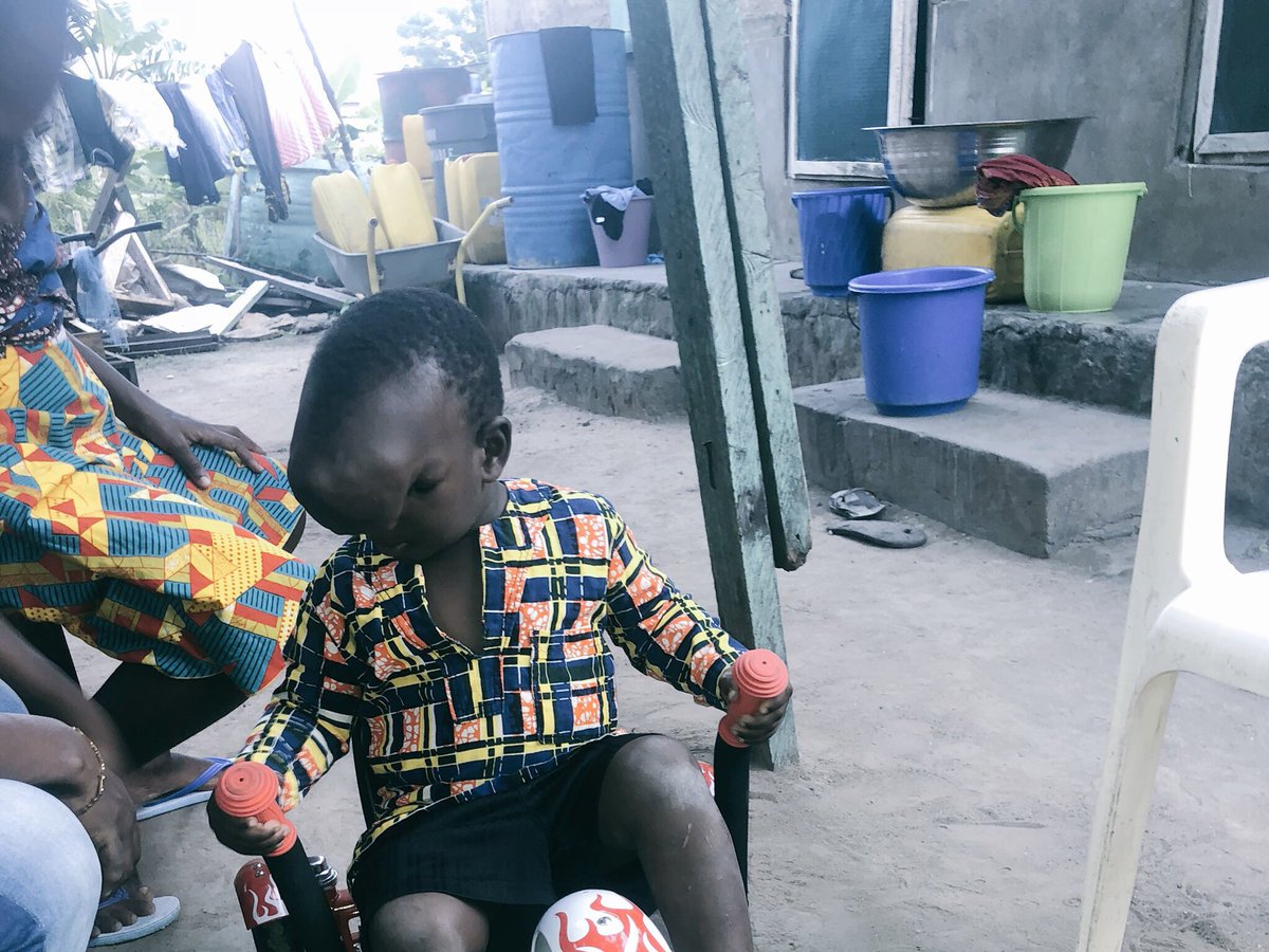 pennien_'s tweet photo. SACRIFICE YOUR LUNCH TODAY TO SAVE A LIFE.  
Moses needs our help. This little boy is a high risk child who needs immediate surgery to fix this giant FRONTO ETHMOIDAL MENINGO-ENCEPHALOCELE. The slightest accident could be fatal. #helpsaveMoses #GW2018  #Ghana #CitiNewsroom https://t.co/Ido0ajXKdS