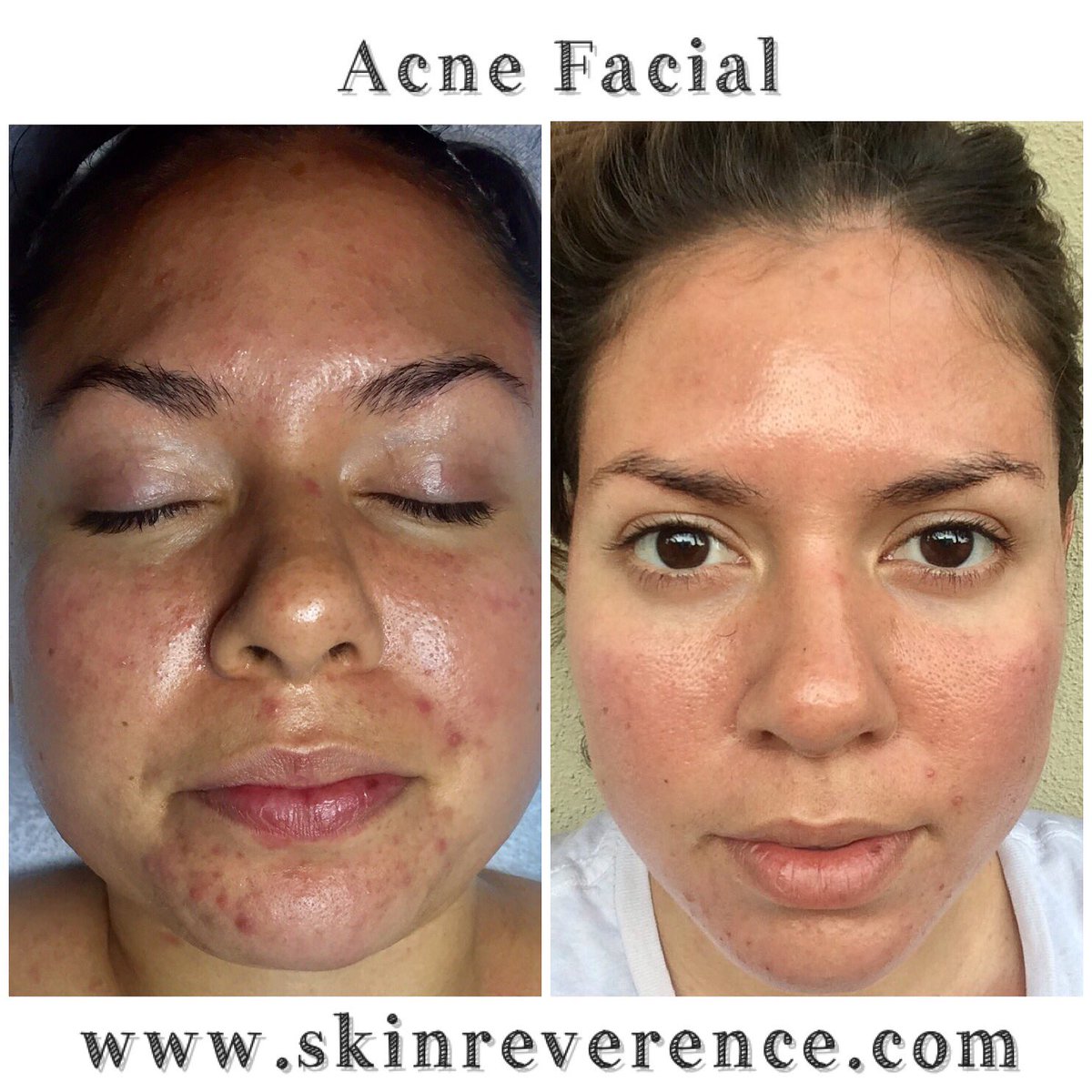NBafiera's tweet photo. What a difference an #acne #facial makes!(results from 1 treatment) Reduce inflammation,deep cleanse the pores&amp; #extract the sebum trapped in your follicles with this treatment. https://t.co/7pGMa2Om78 626-698-8687
#professionalskintreatments #acnetreatment #arcadia https://t.co/aLUHjgu3ra