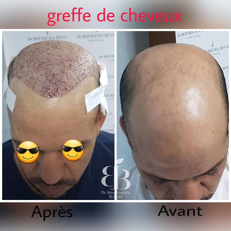 drBourichaBeya's tweet photo. Pas de cicatrices,pas de douleurs et le résultat est parfaitement naturel
لا ندوب ، لا ألم ونتيجة طبيعية تماما زرع الشعر هو الحل لعلاج الصلع
(+216) 99 895 178
(+216) 99 895 187
🌐 https://t.co/ReDivk4DaE
©️clinique de l'espoir🇹🇳️®️ #hairimplant #greffedecheveux https://t.co/23pn4mMDlC