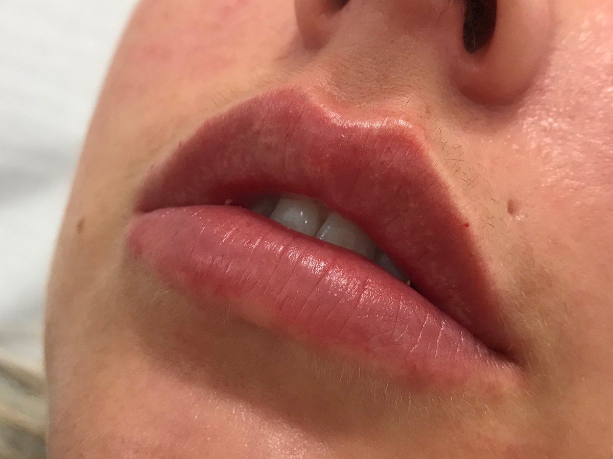 PodBeauty's tweet image. L I P   F I L L E R   💉

1 M L  of filler used to enhance the cupid’s bow 👄

📲 DM TO MAKE AN APPOINTMENT 
📞 01903 260985