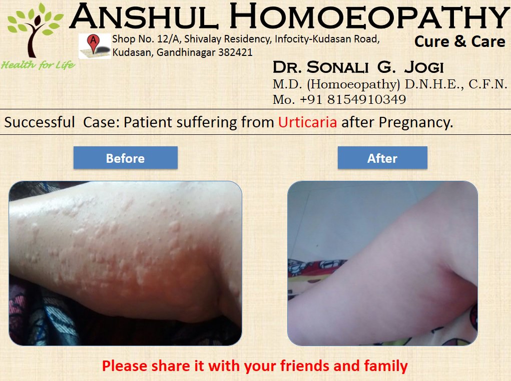homoeo_anshul's tweet photo. Successful case in Urticaria recovery. Patient suffering from Urticaria post pregnancy. #AnshulHomoeopathy #Gandhinagar #Ahmedabad #Homoeopathywonders #skinailment #urticaria #postpregnancy #MDHomoeopath #Homeopathy Pls share it with your friends & family https://t.co/eCLviVE7yq