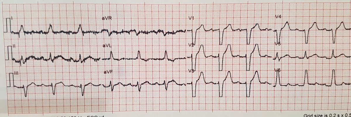 AmboFOAM's tweet photo. This time *with* ECG attached 🤦♂️
Currently pain free, troponin elevated (unknown number)
Cath lab?
#ECG #FOAMcards #Cardiology #STEMI? #OMI? https://t.co/TmYo2zd8IS