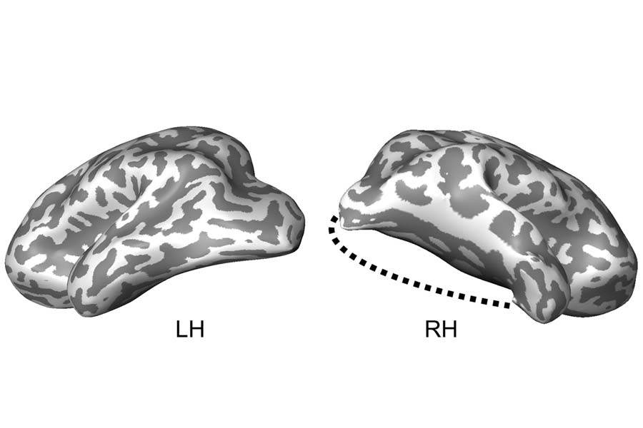 Case Study: Child’s Lobectomy Reveals Brain’s Ability To Reorganize Its Visual System: a groundbreaking new study from <a href="/cmupsych/">CMUPSYCH</a> in <a href="/CellReports/">Cell Reports</a> cmu.edu/dietrich/news/…