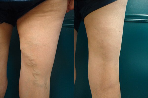 SheenVeinSTL's tweet photo. Varicose veins are NOT the result of walking on concrete or wearing tight clothes.  Let us help you to weed through the wives tales and get you on a path to true relief!  https://t.co/POOzZwwf8q https://t.co/aexu8UhCME
