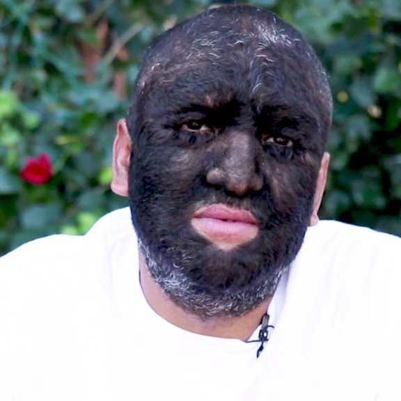BAKBLADECO's tweet photo. Think you have issues with your body hair?
Check out this guy!
Click here to learn about his hair condition.
https://t.co/K1zCbzOQgY
#BAKblade #BAKblade2 #BAKbladeELITE #follicleForrest #BAKhair #backhair #groomingStyle #manscape #manscaping #WorldsHarriestMan https://t.co/U3NHQKKMiA
