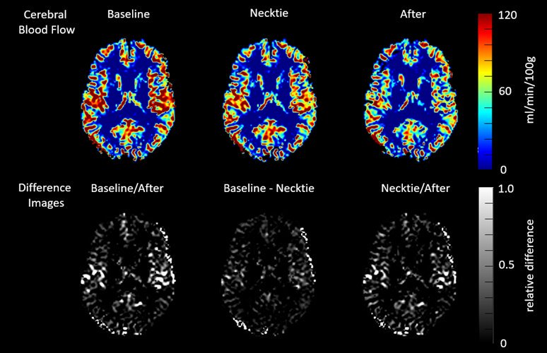 radclass_net's tweet photo. دراسة MRI نشرت في مجلة Neuroradiology توضح أن تروية الدماغ بالدم cerebral blood flow قلت بنسبة وصلت مايقارب 12% عند إرتداء ربطات العنق!

لذلك لابد من الإنتباه من الياقات الضيقة جدا. هذه الدراسة اجريت على 30 شخص. 
المصدر: 
https://t.co/Y1N7bjMUwG https://t.co/cDRR2FFRPe