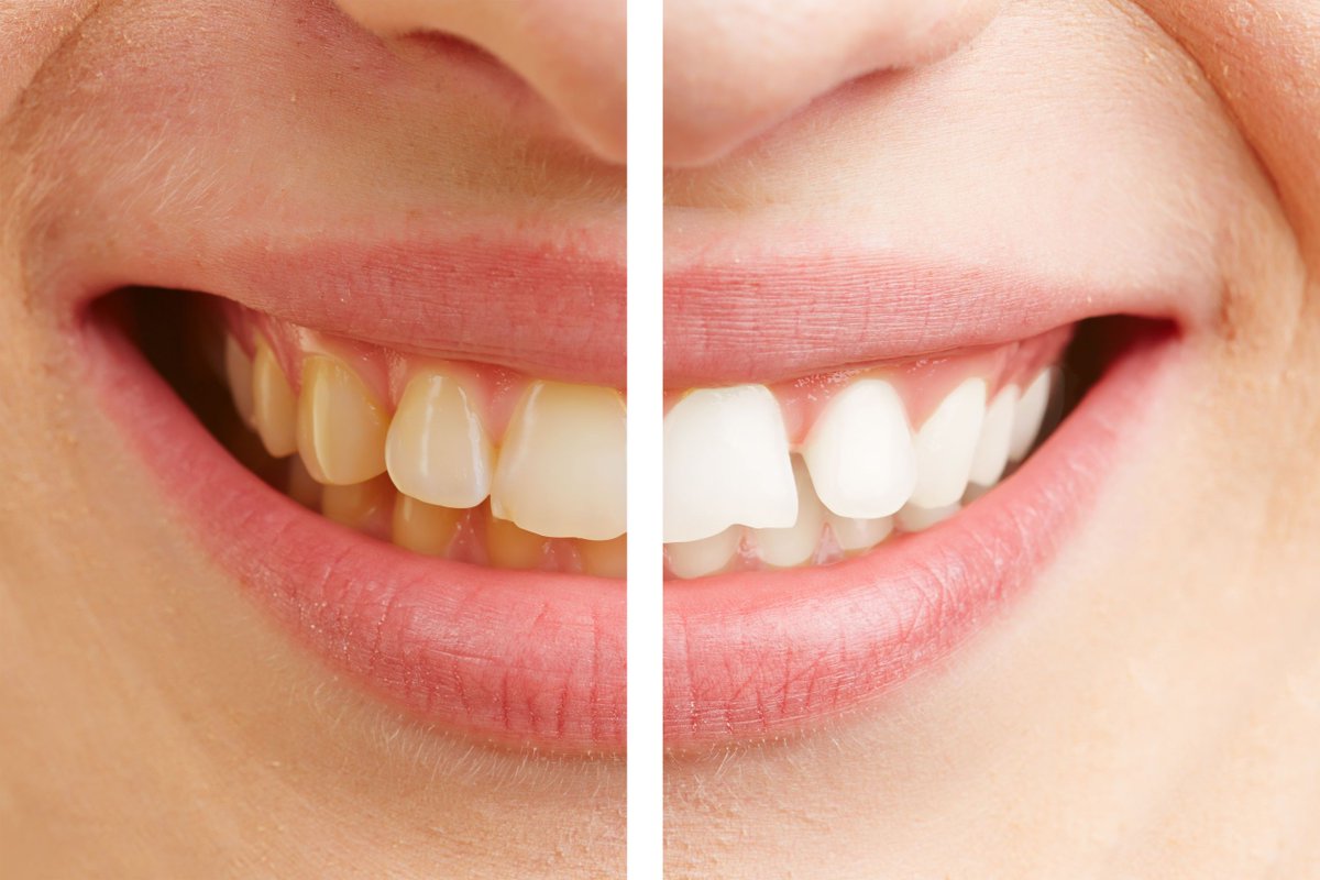 Teeth whitening is a simple, effective cosmetic dental treatment to noticeably enhance your smile in as little as one treatment. 
To learn more about professional teeth whitening and to set up your consultation, please call us today or visit us at: buff.ly/2mWNvY3