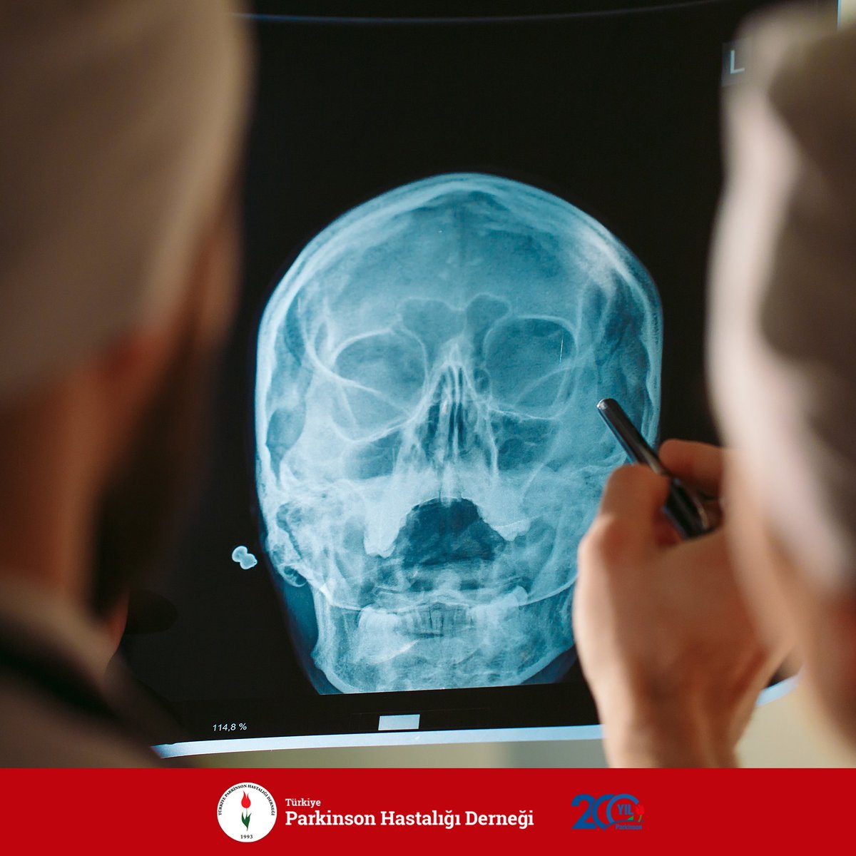 Alzheimer ve Parkinson hastalıkları nörodejeneratif hücre kaybına giren hastalıklardır. Ancak belirtileri açısından farklılık gösterir. Alzheimer hastalığı öncelikli olarak zihinsel işleyişi etkilerken Parkinson hastalığı, hareketin öncelikli olarak etkilendiği bir hastalıktır.