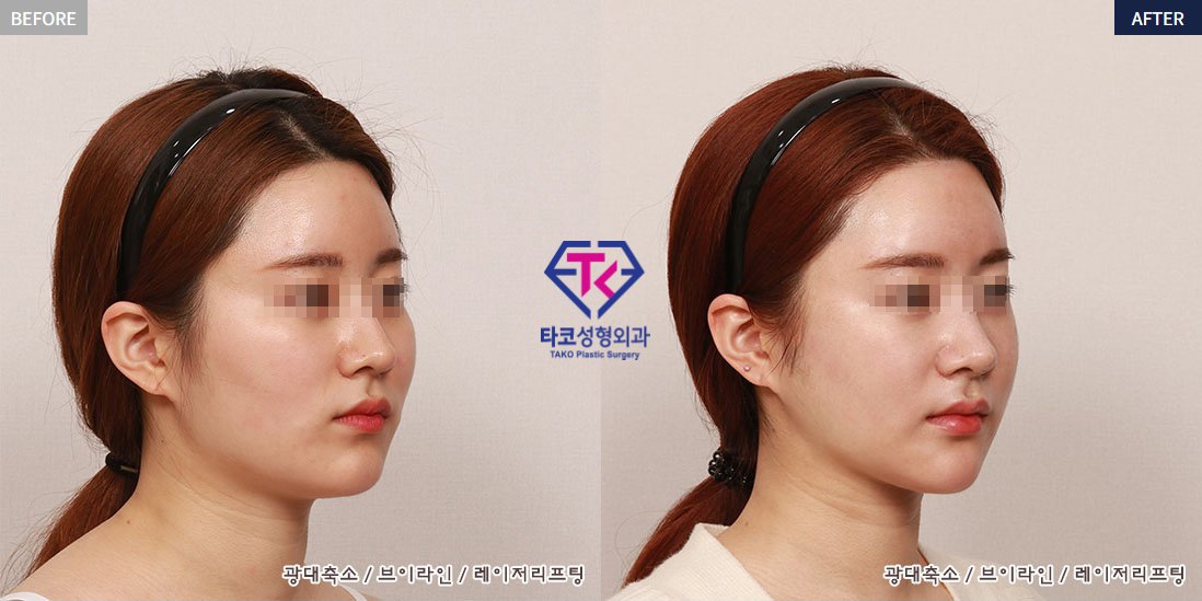 Tako美容外科 در توییتر いつも気になる目立つ非対称や広い余白 丸くて大きい顎 を憧れの目立たない非対称 自然に小さくて余白も少ない小顔 に Tako美容外科 キムタクホ 先生の ｖライン トリプル頬骨縮小 脂肪吸引 なら想像が現実に Tako の ｖ