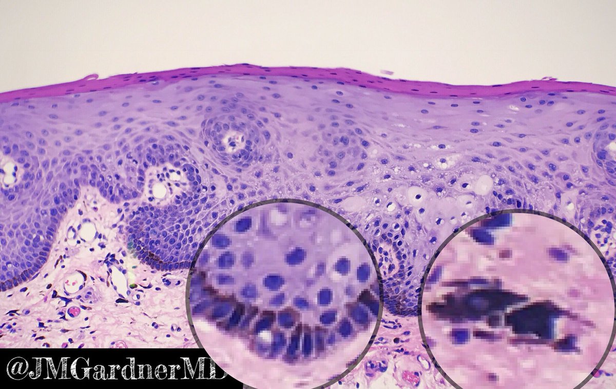 macule melanotic Labial or Oral Melanotic Macule Benign, asymptomatic, and often  underdiagnosed. Swipe to learn how to recognize, diagnose, and manage this  simple yet important lesion! #thebasicdentist #rguhs #kuhs #tnmgrmu  #OralPathology #MelanoticMacule #DentalFacts