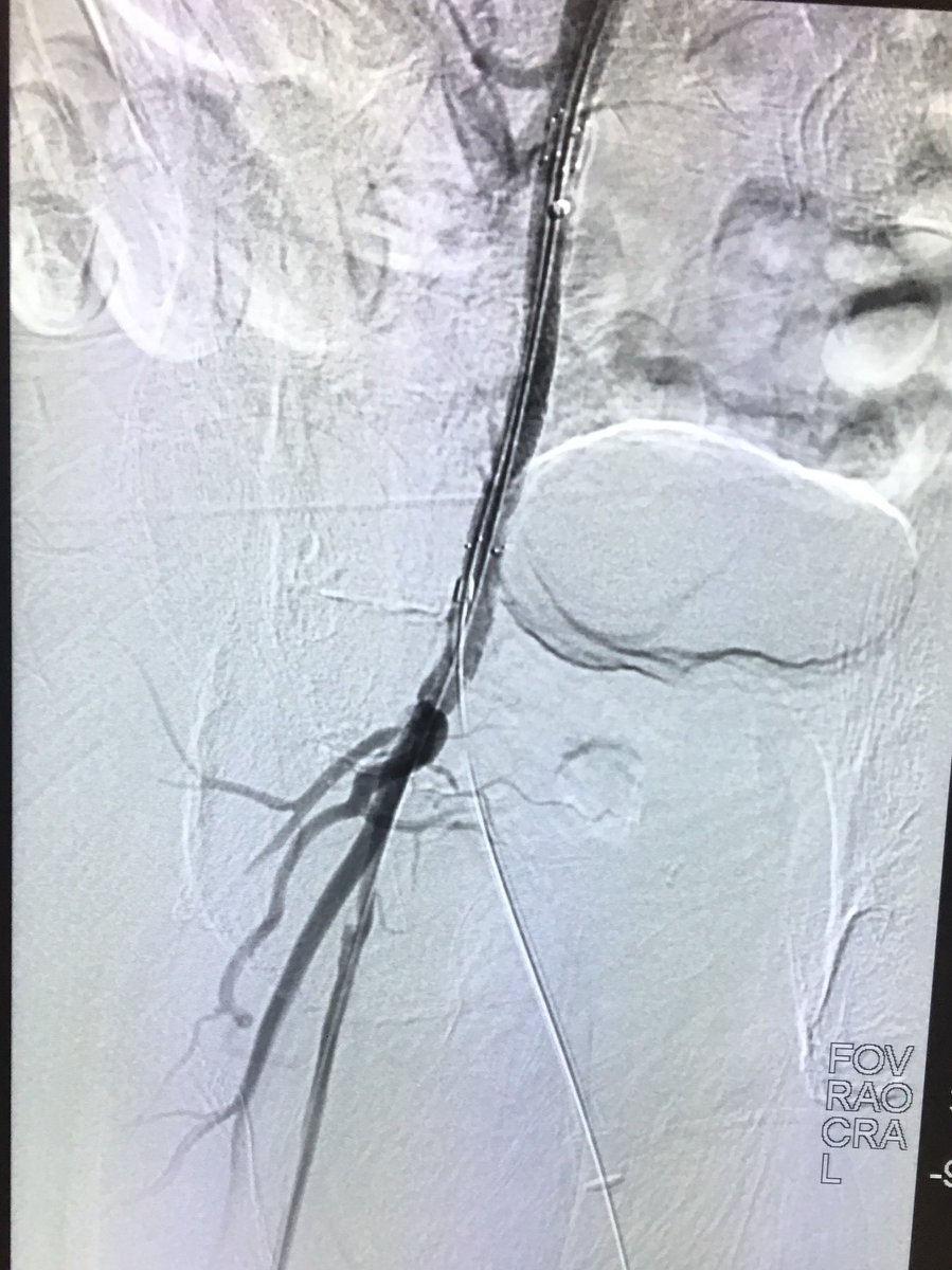 Right external iliac occlusion. Wire went subintimally antegrade and retrograde. Outback catheter deployed to re-enter true lumen. Successful drug-eluting stent placement <a href="/UICOMPRadiology/">UICOMP Radiology</a> <a href="/SIRRFS/">SIR RFS</a> #SIR #IRad #TwittIR #JVIR  <a href="/SIRspecialists/">Society of Interventional Radiology</a>