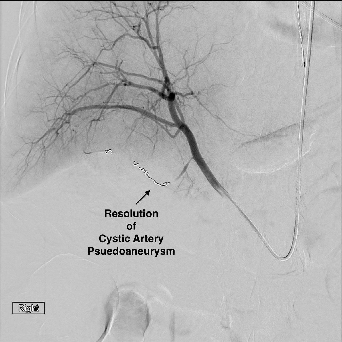 #radialfirst #embolization of the cystic artery <a href="/GuthrieClinic/">Guthrie</a> prior to #cholecystectomy

#irad
#radiology
