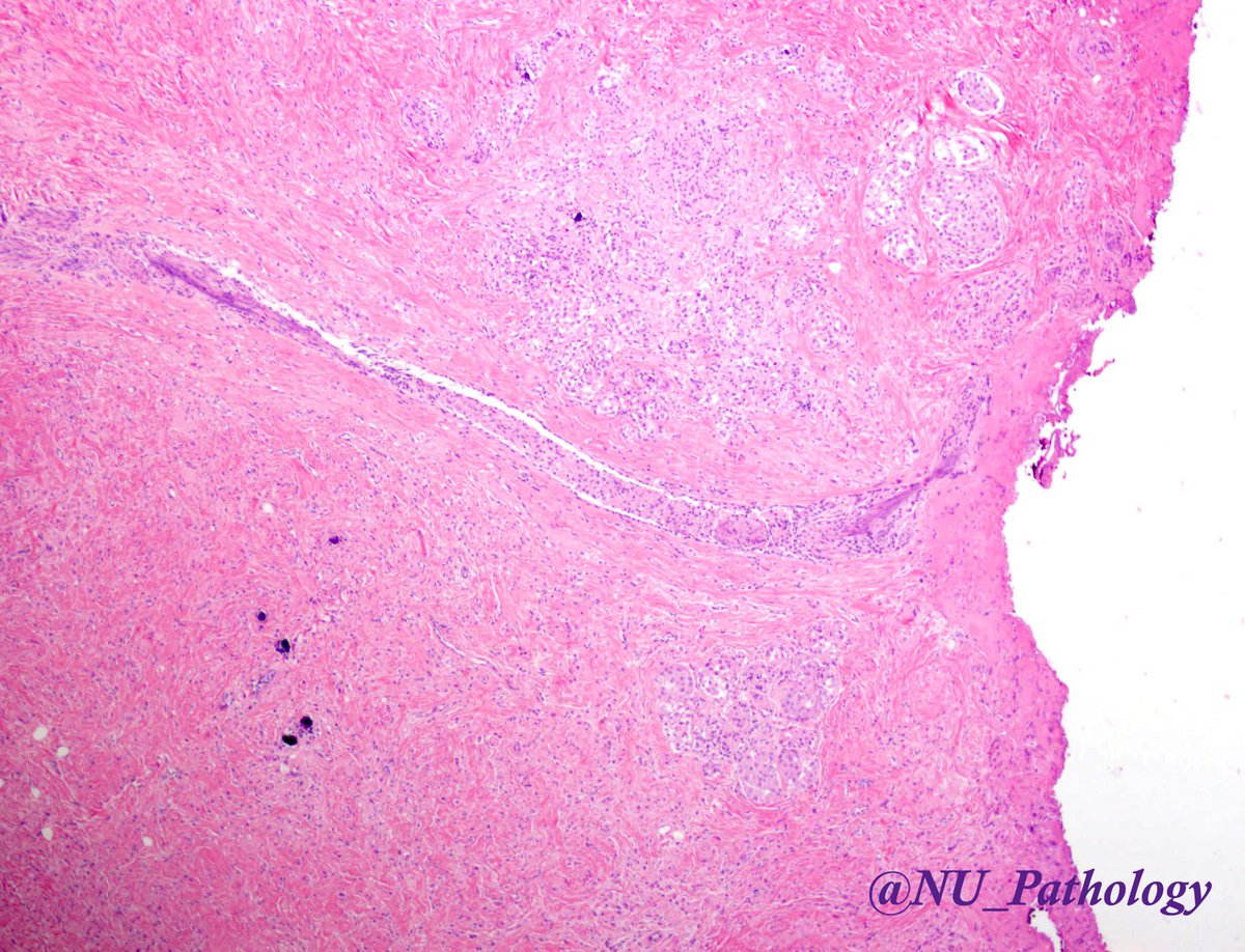NU_Pathology's tweet photo. Case of the month, August 2018: This is a breast lesion from a middle aged female, who initially presented with calcifications on imaging. What is your diagnosis? #breatpath #pathology #northwesternpathology https://t.co/5M8NRxWrtI