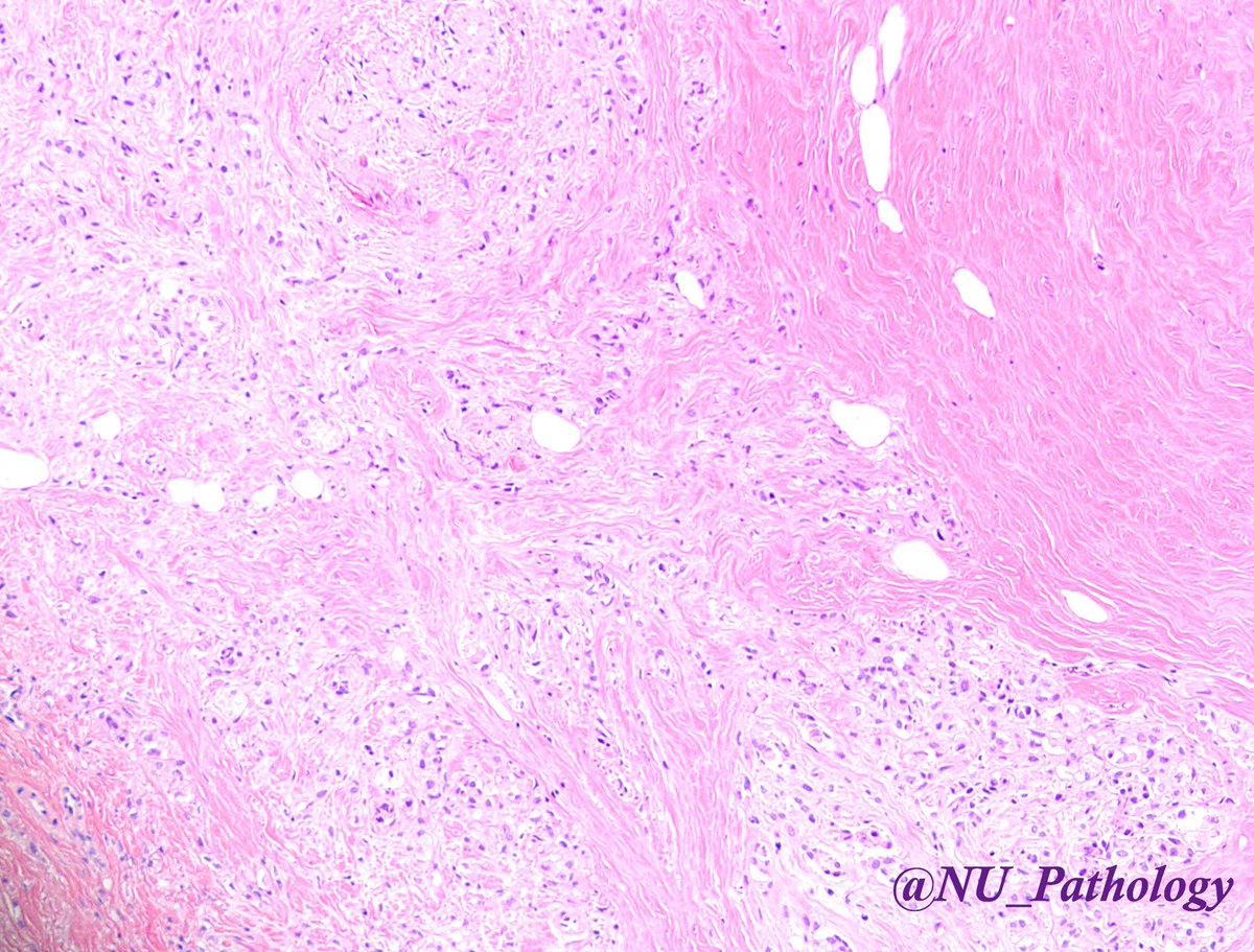 NU_Pathology's tweet photo. Case of the month, August 2018: This is a breast lesion from a middle aged female, who initially presented with calcifications on imaging. What is your diagnosis? #breatpath #pathology #northwesternpathology https://t.co/5M8NRxWrtI
