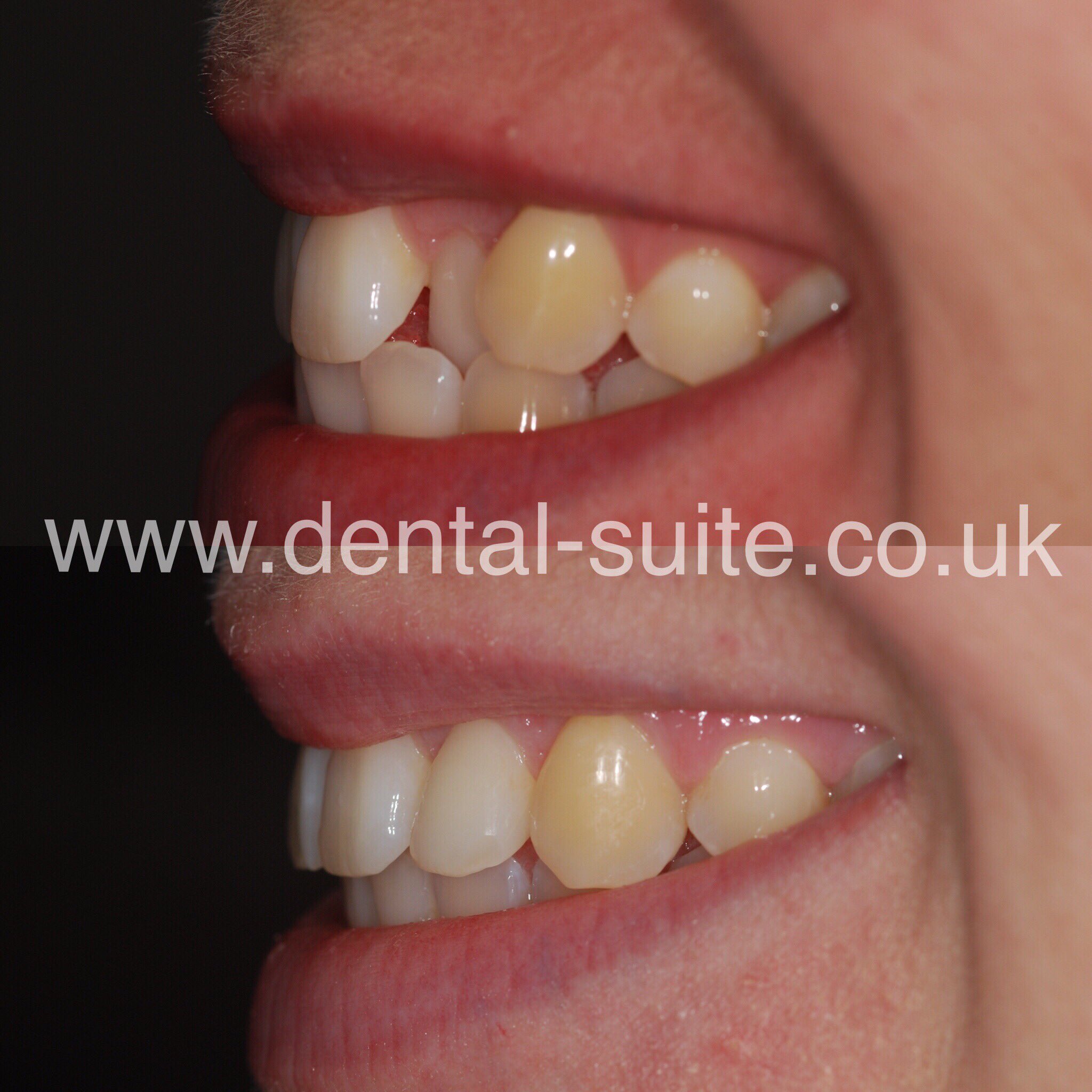 The Dental Suite on Twitter "An instanding tooth which was