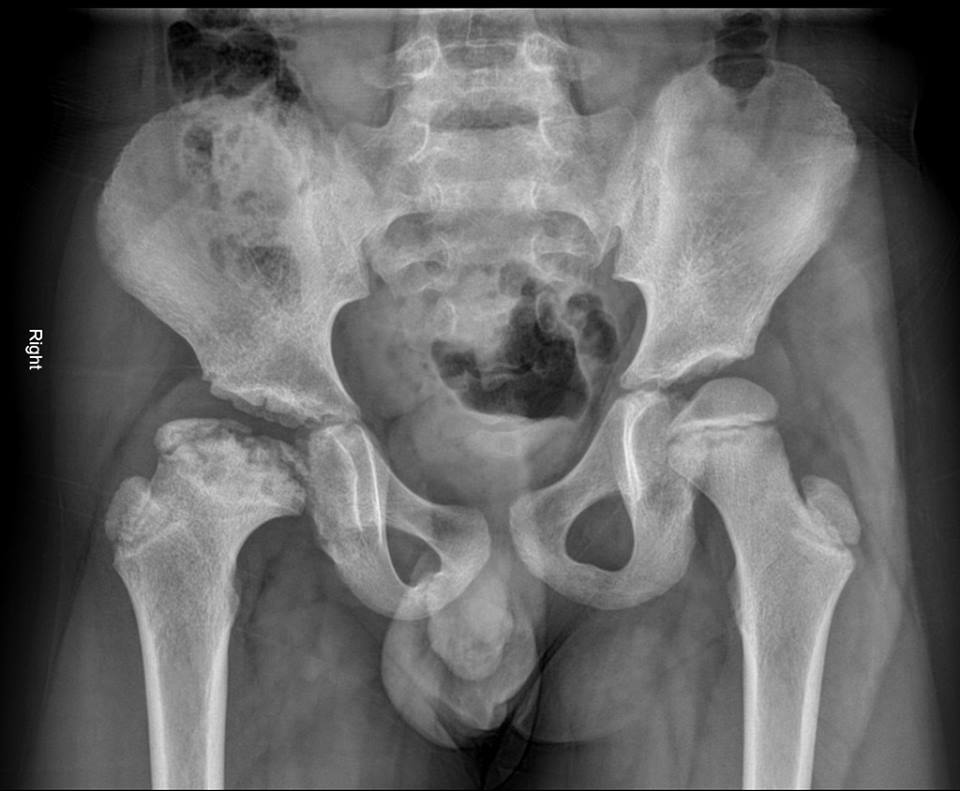 RadiologySigns's tweet photo. Q: Cracking plain radiograph - what does it show?
ANSWER: https://t.co/H42gQ2pb2n #FOAMrad #FOAMed https://t.co/IUKsvxPljT