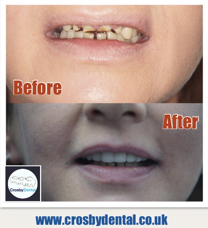 Another fantastic before and after picture from one of our patients 

If you are interested in getting the smile you’ve always wanted then please call us on 01512860330 

#dentistliverpool #followus #crosbydental #perfectsmile #cosmeticdentistry