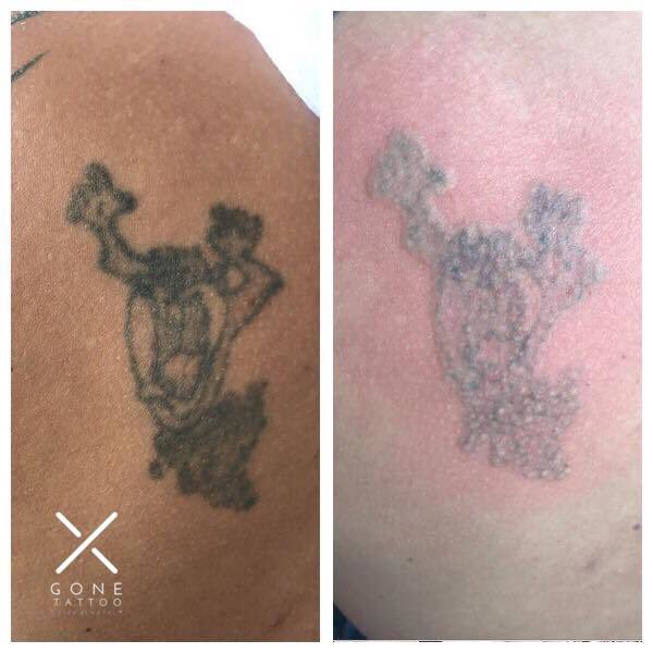 GoneTattoo's tweet photo. This photo was taken directly after a tattoo removal session, what you’re seeing is called ‘frosting’ which is white residue caused by rapid local heating of the area the ink pigment is broken up in. It usually only lasts 10-15 minutes after a session.
#gonetattoo #lasertattoo https://t.co/Scn8DkgjNt