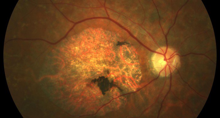 Ins_Macula's tweet image. #Eyescan related pathologies:

🔹 Retinal detachment.

🔹 Proliferative diabetic retinopathy.