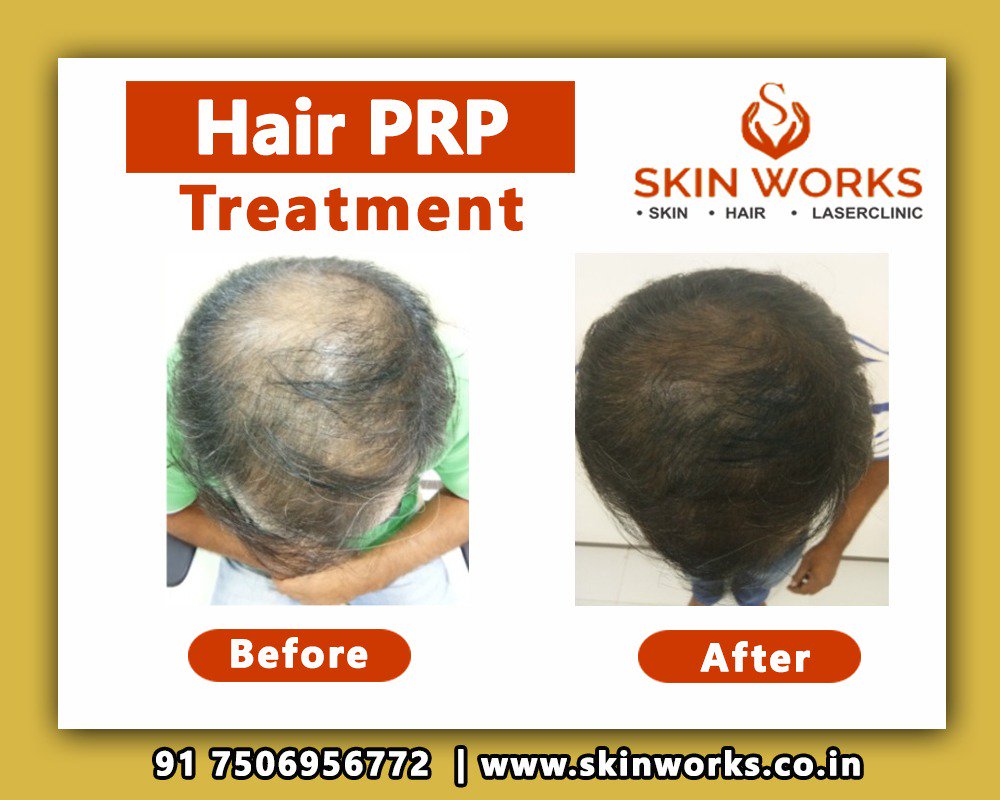 Skinworksclinic's tweet image. Advance PRP Hair Treatment for Hair Regrowth
Consult us Today @075069 56772
#hair #prpsolutions #prphairtreatment #hairgrowth #HairRegrowth #advanceprp #skinworks