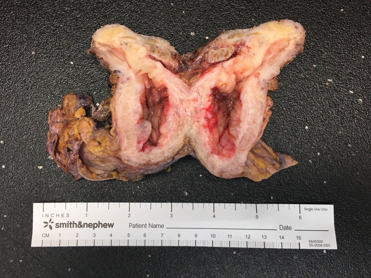 #grossing Bladder Cystoprostatectomy; It's always important to begin with a good dissection and grossing ! #pathology #patho
#residentlife