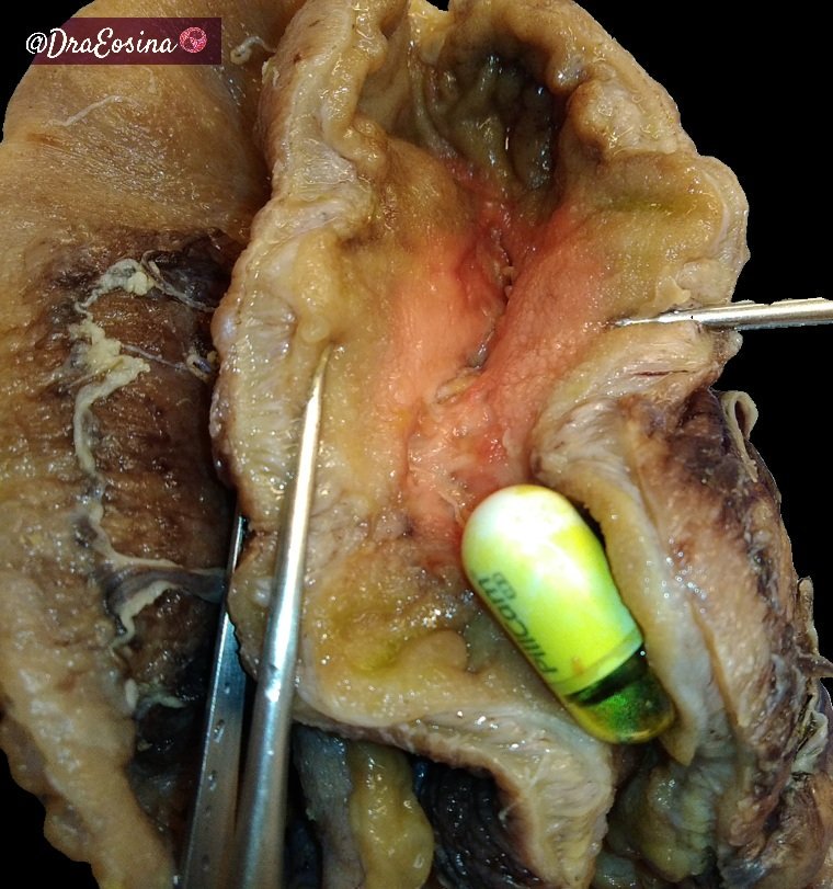 Before a Pillcam capsule is taken, an absorbable patency one is administered. If it gets through the whole bowel, one can be confident that the real one won't get trapped. In a very few cases, though, it does.
Here is one.
#GIPath #GrossPath #Pathology