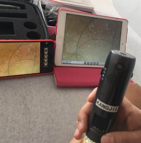 When examining with the digital dermatoscope, the images can be real-time displayed on IPAD or mobilephone through WIFI.