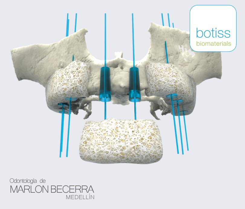 ombmedellin's tweet image. Obtén óptimos resultados  de regeneración ósea en tus procedimientos dentales con el sistema de regeneración de botiss. ¡Agenda tu cita ahora! 👉PBX: 3222728 #MotivosParaSonreir #SaludDental #Botiss #BotissBiomaterials
#ImplantesDentales #OdontologíaCosmética